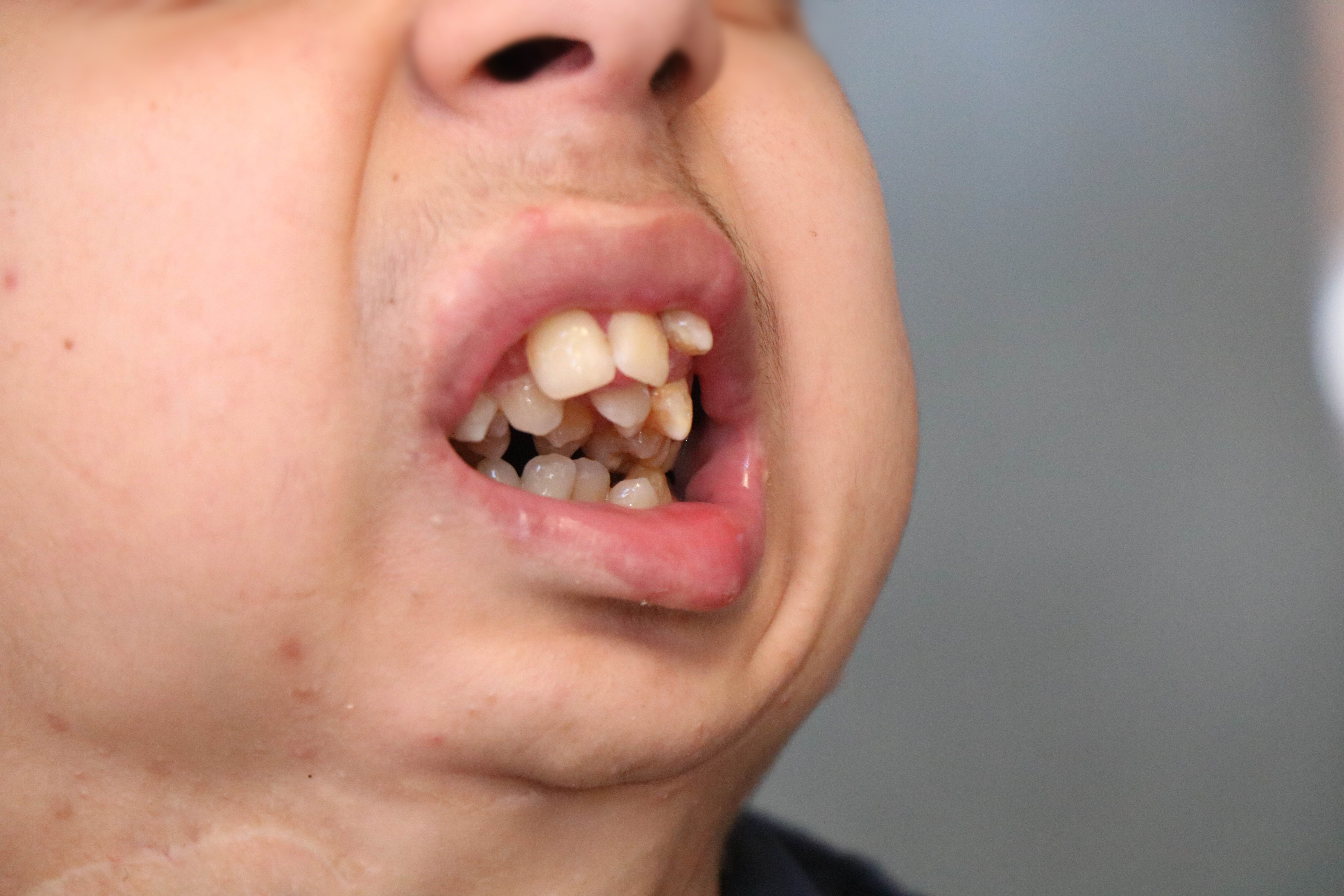 Tüm dişleri üst çenesinde çıkan gencin yardım çığlığı